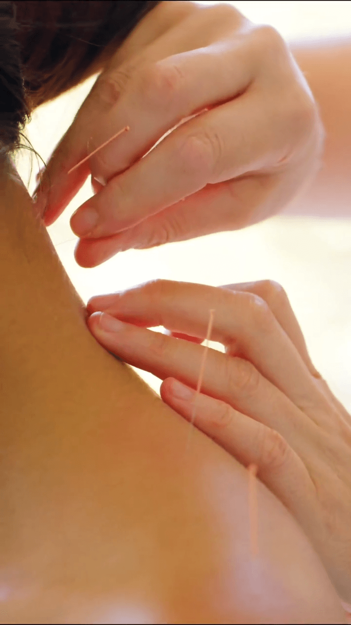 Acupuncture treatment representing pain and muscle tension care