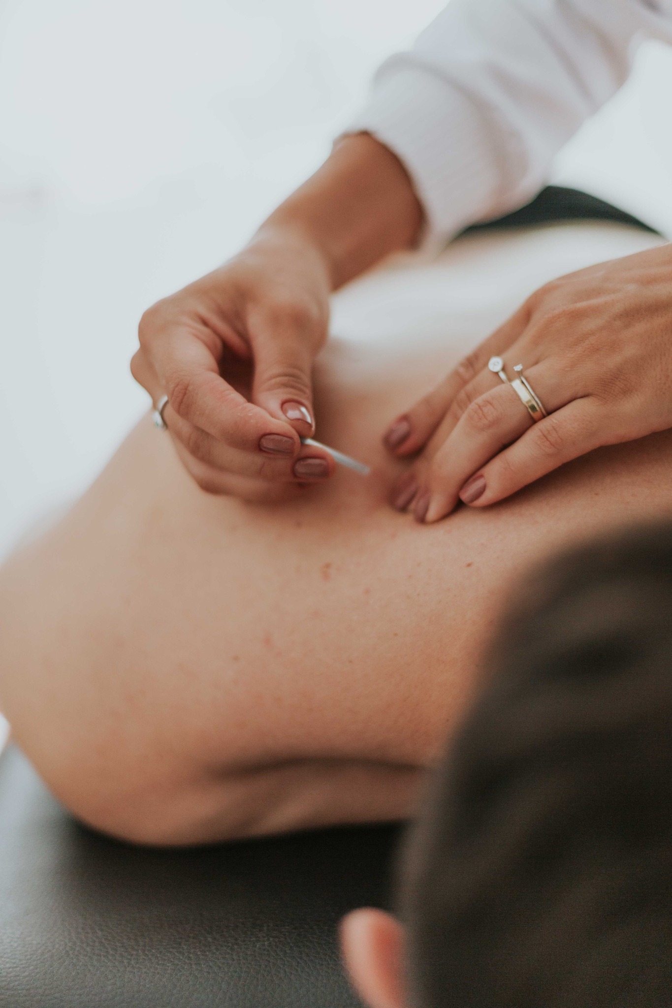A licensed acupuncturist providing a gentle treatment